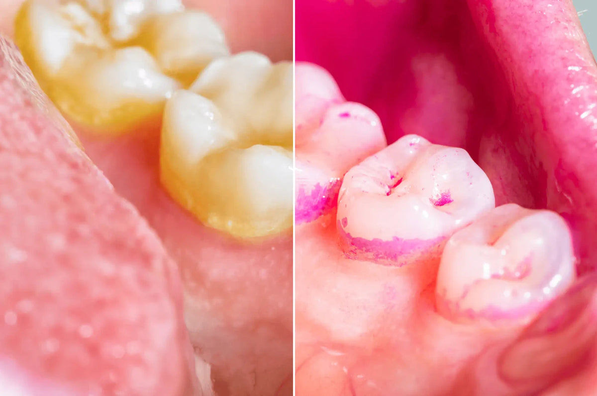 Placca dentale prima e dopo l’applicazione del colorante